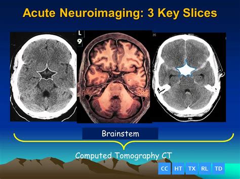 Acute Brain Imaging The 3 Slice Method Youtube