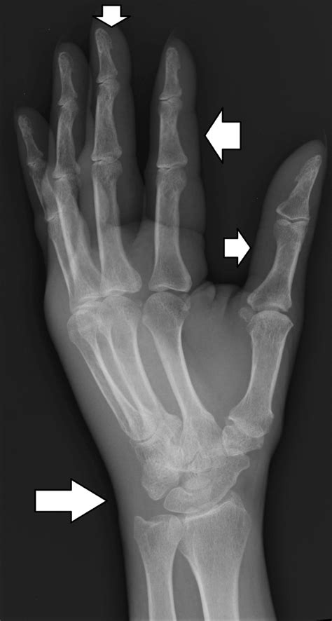 X Ray Of The Wrist Joint Showing Soft Tissue Swelling Download