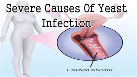 What Causes Vaginal Yeast Infection Severe Causes Of Yeast Infection