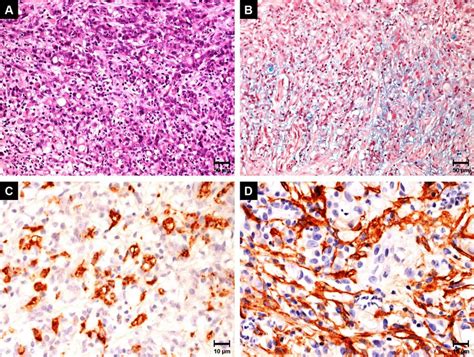 Gastric Signet Ring Cell Carcinoma Characterized By The Presence Of