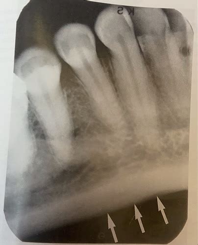 Chapter Normal Anatomy Intraoral Images Flashcards Quizlet