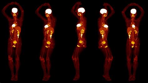 Whole Body Pet Scanner Produces 3d Images In Seconds