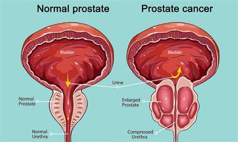 Prostate Cancer Symptoms Causes Types And Treatment