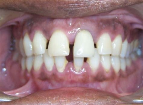 Orthodontics Philadelphia Pa Bala Cynwyd Pa Bensalem Pa Kellyn Hodges Orthodontics