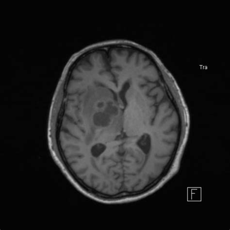 Cerebral Abscess Radiology Case