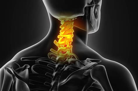 Neck Pain Cervical Disc Herniation And Cervical Radiculopathy By