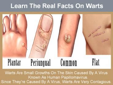 PPT Learn The Real Facts On Warts PowerPoint Presentation Free To