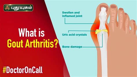 What Is Gout Arthritis And How To Cure Doctor On Call 07012019