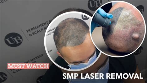 Learn How To Remove Botched Scalp Micropigmentation ️behind The Scenes