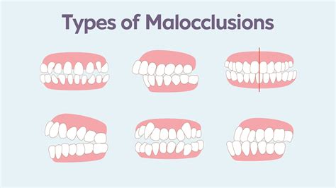 Malocclusion Treatments Types And Consequences