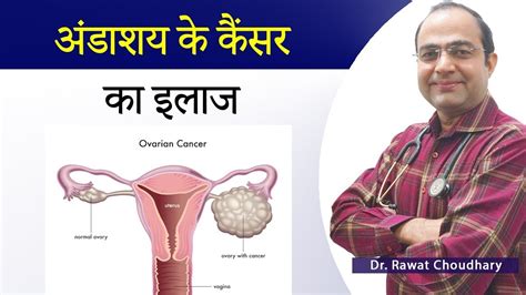 Ovarian Cancer Treatment अंडाशय के कैंसर का इलाज Best Treatment Of Cancer Youtube