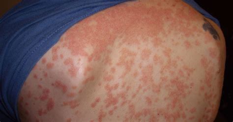 Guttate Psoriasis Causes Symptoms And Treatment