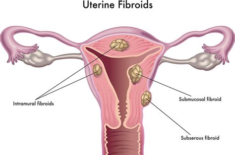 Uterine Fibroids Diagnosis And Treatment Dr Chanchal Sharma