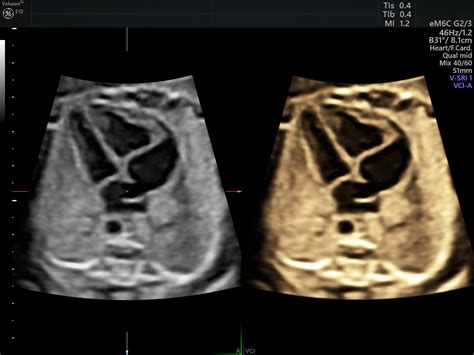 Fetal Heart Defects Ultrasound Empowered Womens Health