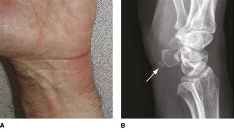 Calcium Deposits In The Hand And Wrist Jaaos Journal Of The