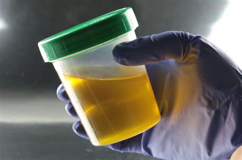 Urina com cor anormal saiba as possíveis causas e o que fazer Minha Vida