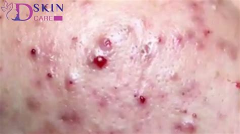 Pimple Popping Cyst Removal Blackhead Removal Te026 Oddly