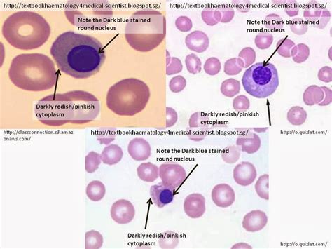 Haematology In A Nutshell Nucleated Rbcerythroblastemia Nrbc