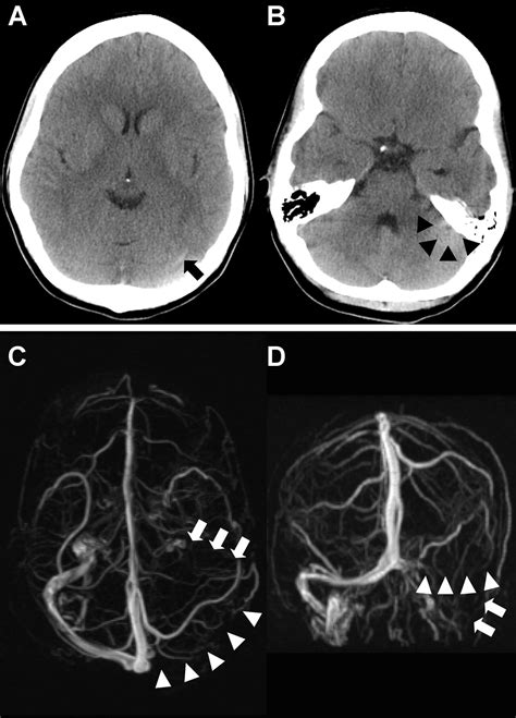 Cerebral Venous Sinus Thrombosis Fig 2 Local Thrombolysis For Severe