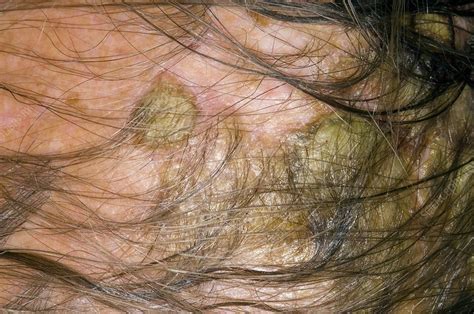 Seborheic Eczema On The Scalp Stock Image C0072691 Science Photo