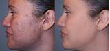 Photos of Laser Treatment To Remove Scars On Face