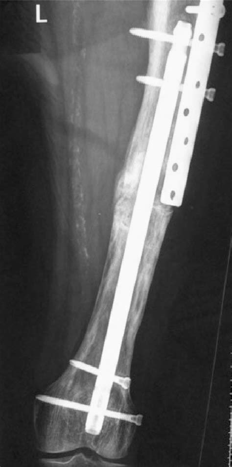 Figure 2 From Pagets Disease Of The Femur Peri Implant Fracture 39