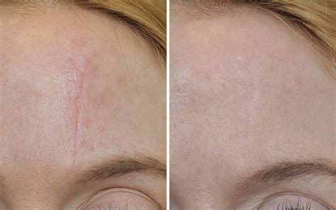 Scar Laser Removal Before And After
