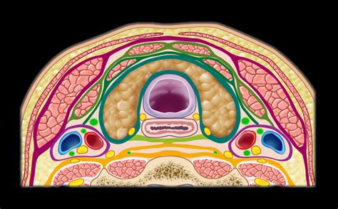 Cervical Carotid Artery Dissection Mri Online