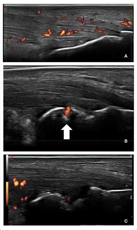 Longitudinal Scans Of Achilles Tendon In Spa A Increased Thickness