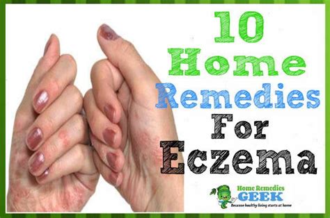 Pin By Home Remedies Geek On Eczema Home Remedies Home Remedies For