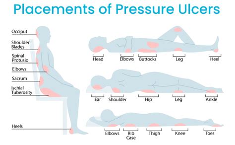 What Are Pressure Ulcers Identification Prevention And Management