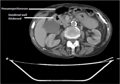 Ct Scan Showing Deformed Duodenal Bulb And Pneumoperitoneum Download