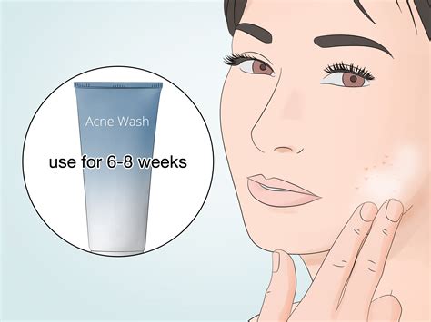 3 Ways To Wash An Acne Prone Face Wikihow