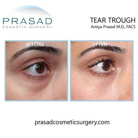 Effective Treatment Options For Bags Under The Eyes Dr Prasad Blog