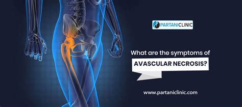 What Are The Symptoms Of Avascular Necrosis Partani Clinic
