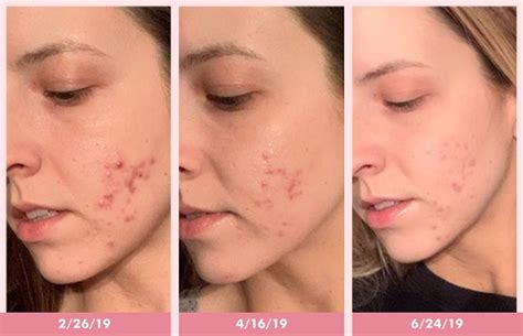 What S The Best Makeup To Cover Acne Scars Infoupdate Org