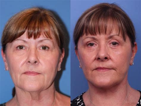Facelift Before And After Pictures Case 214 Scottsdale Az Hobgood Facial Plastic Surgery