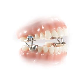 The mara (short for mandibular anterior repositioning device) is made by allessee orthodontics … Our Treatments | Doyle Orthodontics