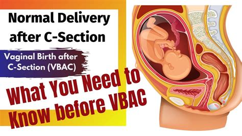 Normal Delivery After Previous Cesarean Vaginal Birth After Cesarean VBAC Risks And