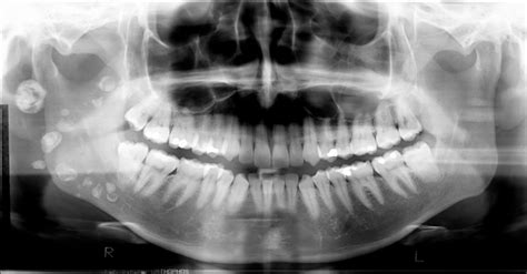 Panoramic Radiography — Diagnosis Of Relevant Structures That Might