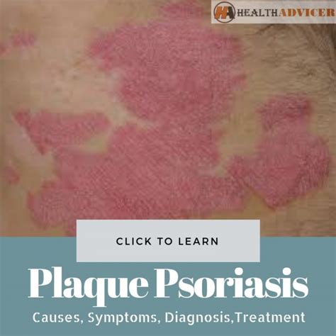 Plaque Psoriasis Causes Picture Symptoms And Treatment
