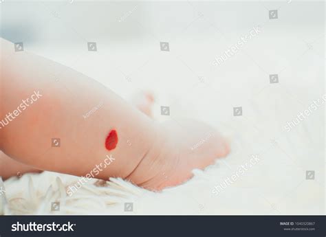 Hemangioma Newborn Baby Girl On Leg Stock Photo 1040320867 Shutterstock