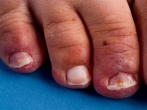 Discoid lupus, sle, subacute cutaneous lupus, systemic lupus erythematosus. Chilblain lupus