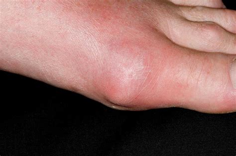 Gout Of The Big Toe Photograph By Dr P Marazzi Science Photo Library My XXX Hot Girl