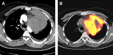 Imaging Of The Anteriorprevascular Mediastinum Radiology Key