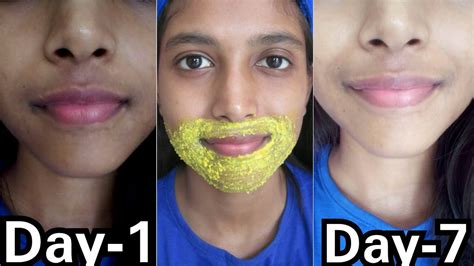 Remove Pigmentation Dark Patches Around Mouth 100 Result In 3 Use