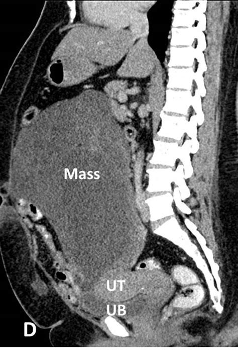 Abdominal Liposarcoma Radiology Cases