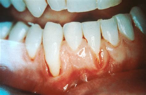 What Are White Gums Causes And Treatment