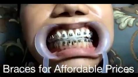 Affordable And Cheap Braces Fashion Innovation Youtube