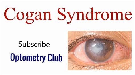 Cogan Syndrome Introduction Clinical Features Diagnosis And Treatment